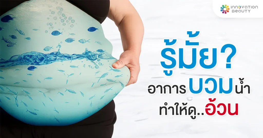 อาการบวมน้ำ