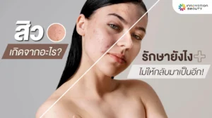 สิวเกิดจากอะไร? รักษายังไง? ให้ไม่กลับมาเป็นอีก!