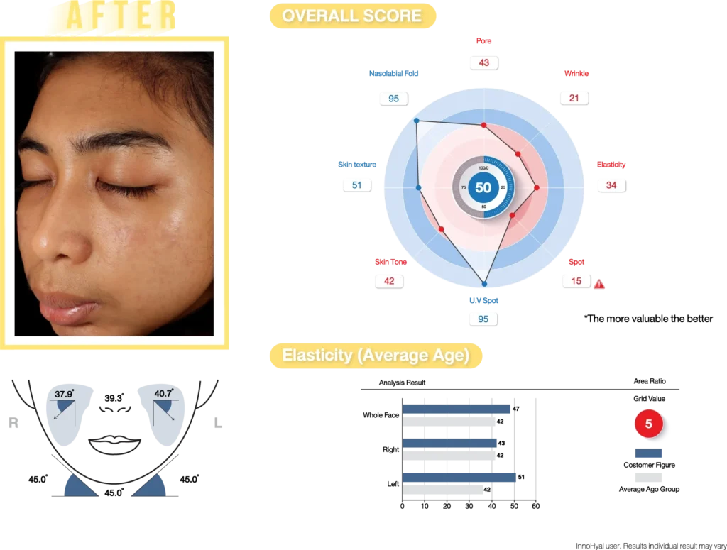research_after_hyal_INNO_IMG