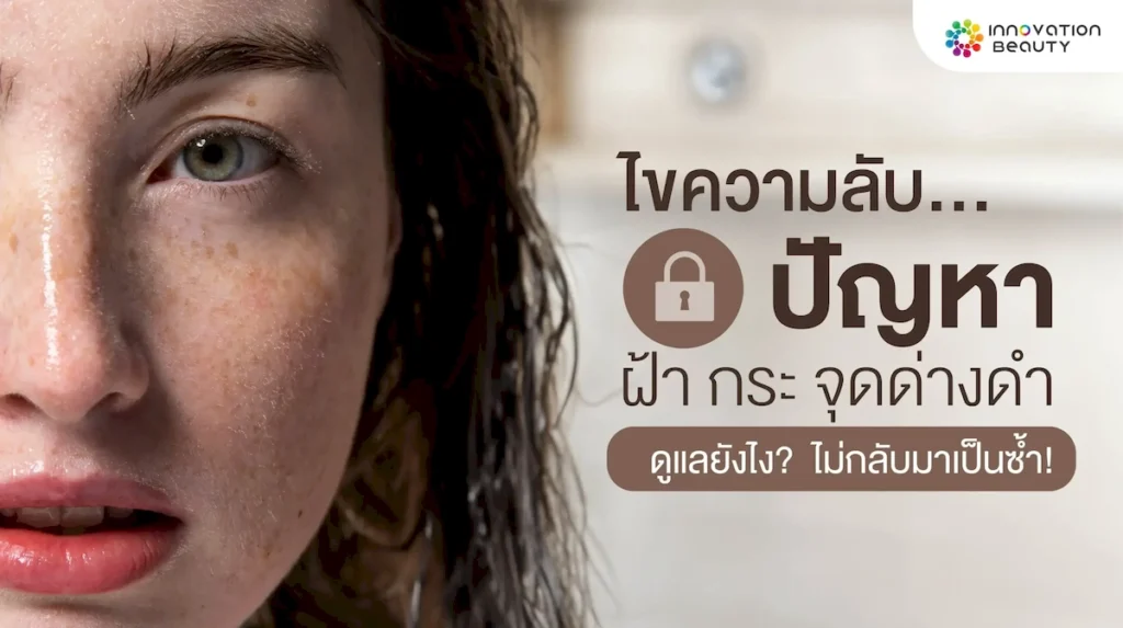 ไขความลับ! ปัญหา ฝ้า กระ จุดด่างดำ ดูแลรักษายังไง ? ไม่ให้กลับมาเป็นซ้ำ