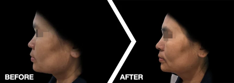 BA_final_hirhino1_INNO_IMG