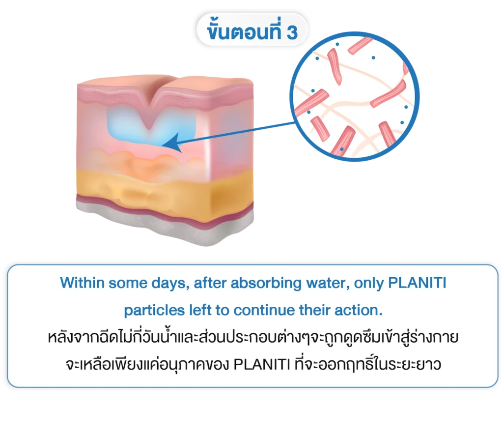 planiti การเตรียมตัวหลังใช้ 3-INNO-IMG