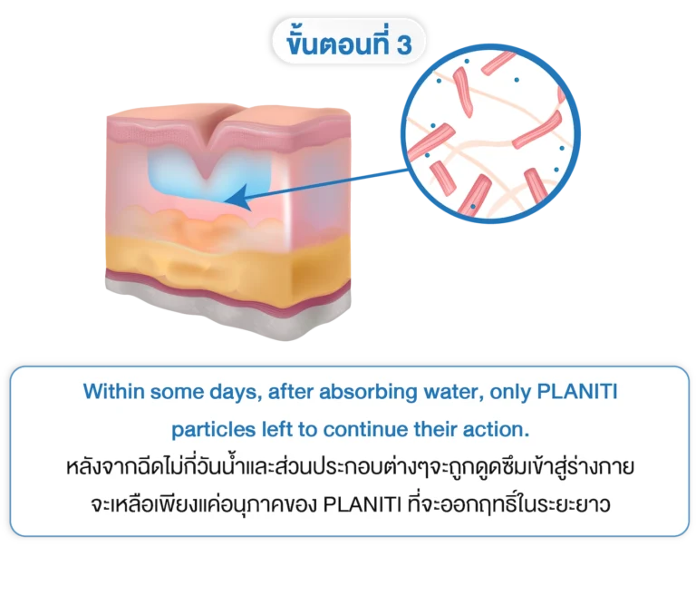 planiti การเตรียมตัวหลังใช้ 3-INNO-IMG