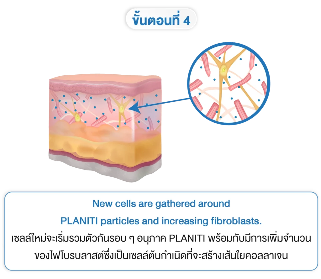 planiti การเตรียมตัวหลังใช้ 4 f-INNO-IMG