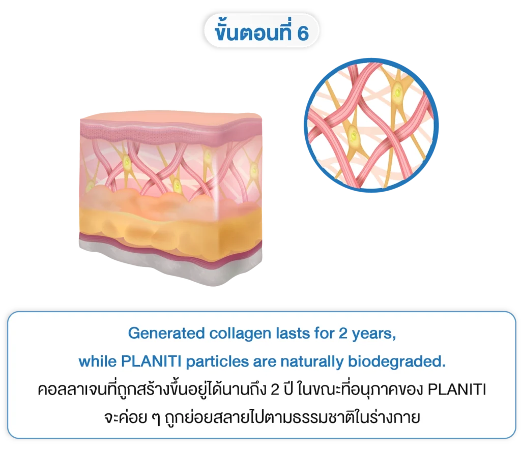 planiti การเตรียมตัวหลังใช้ 6-INNO-IMG