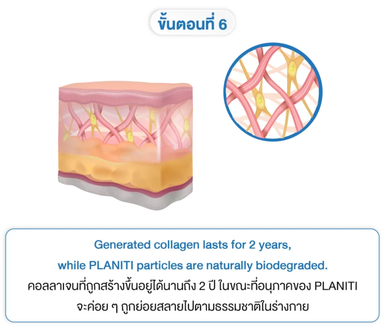 planiti การเตรียมตัวหลังใช้ 6-INNO-IMG