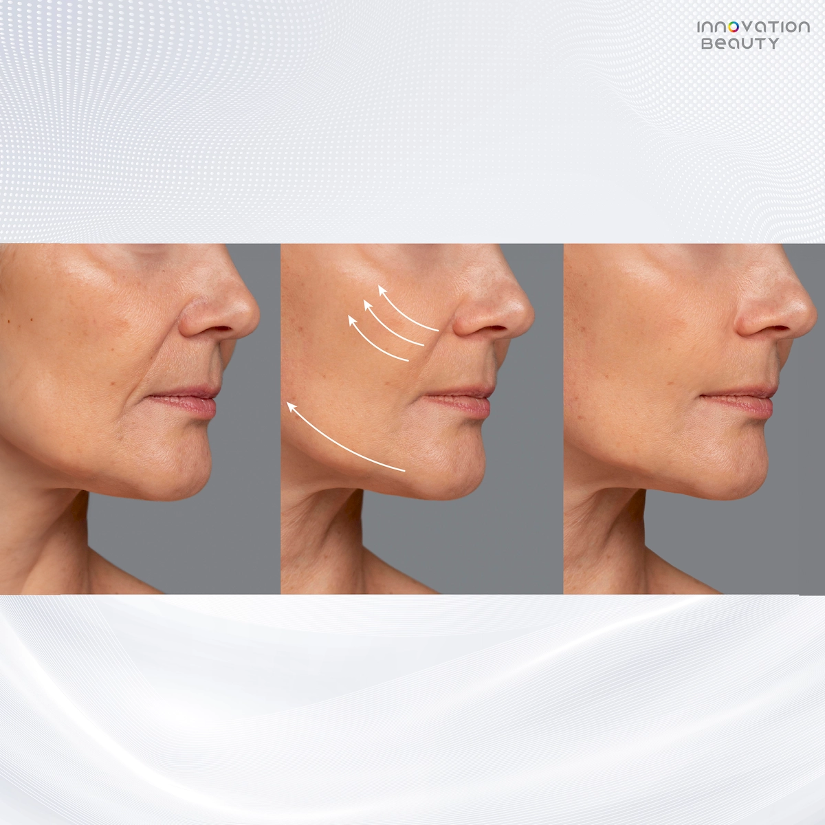 กลุ่มลูกค้าที่สามารถ ร้อยไหมร่องแก้ม แล้วเห็นผลลัพธ์ชัดเจน