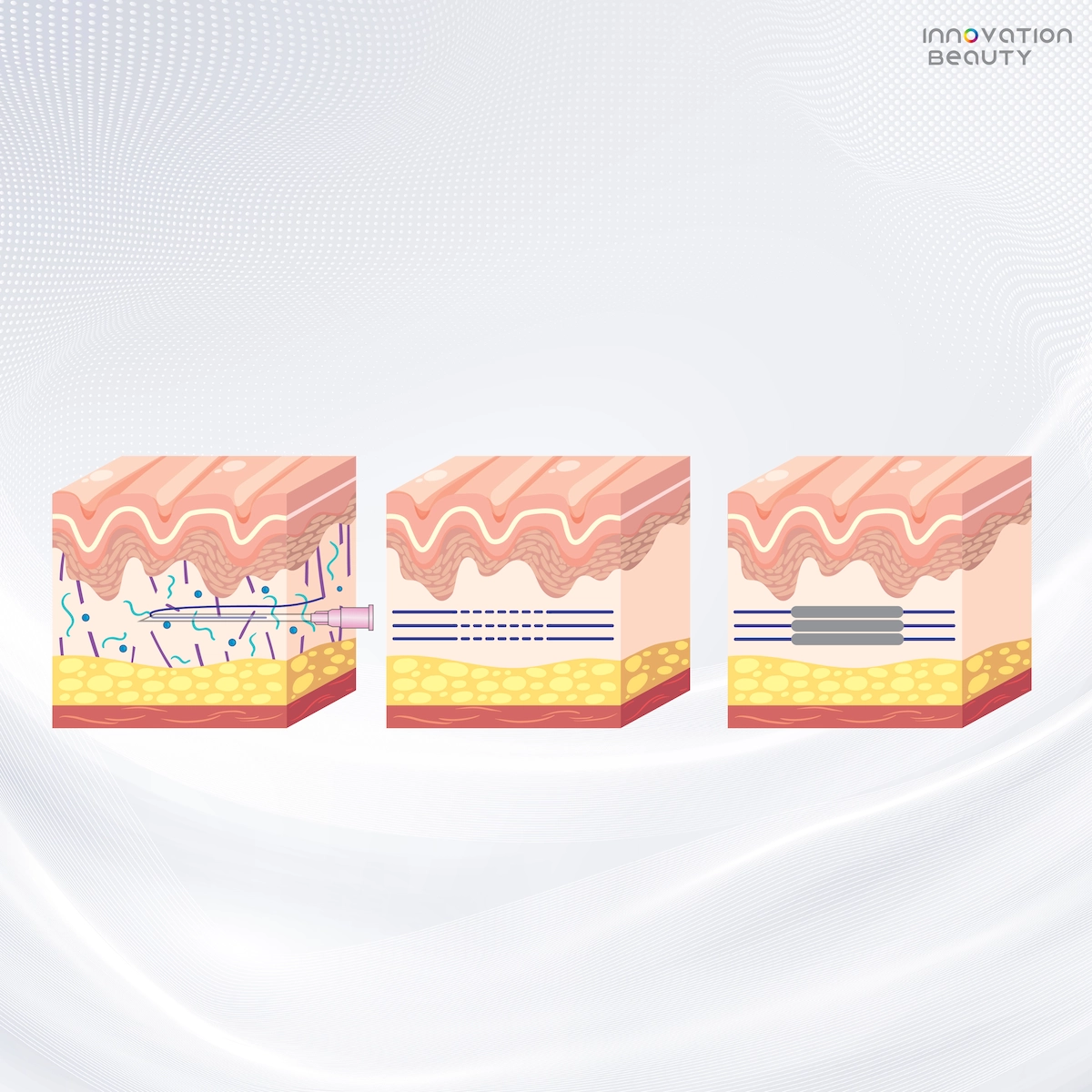 หลักการทำงานของการ ร้อยไหมร่องแก้ม