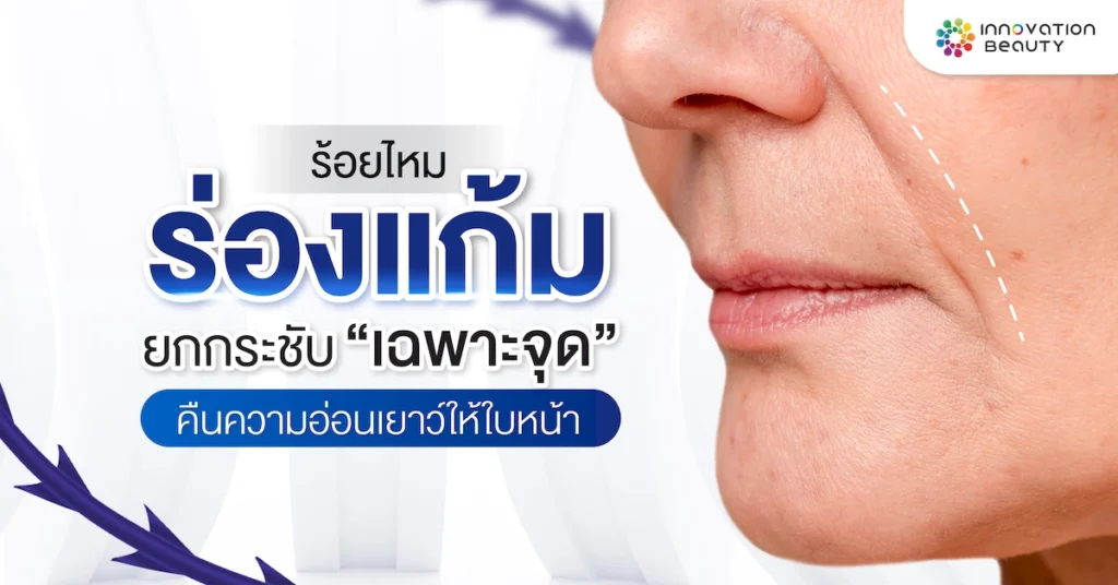 ร้อยไหมร่องแก้ม ยกกระชับเฉพาะจุด คืนความอ่อนเยาว์ให้ใบหน้า