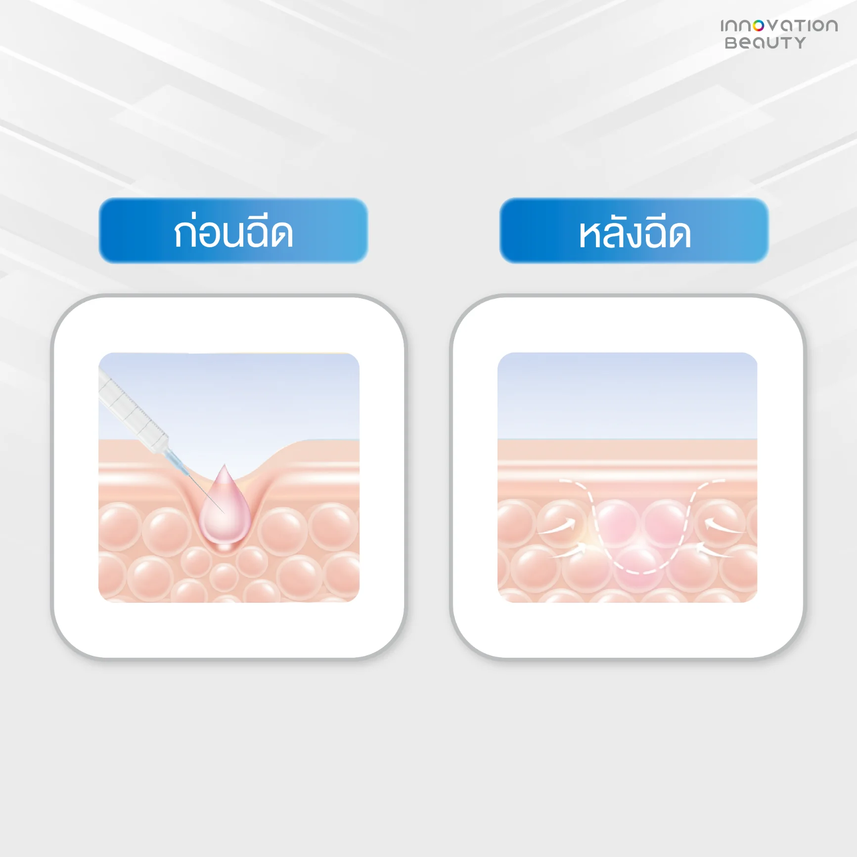 การทำงานของBiostimulator