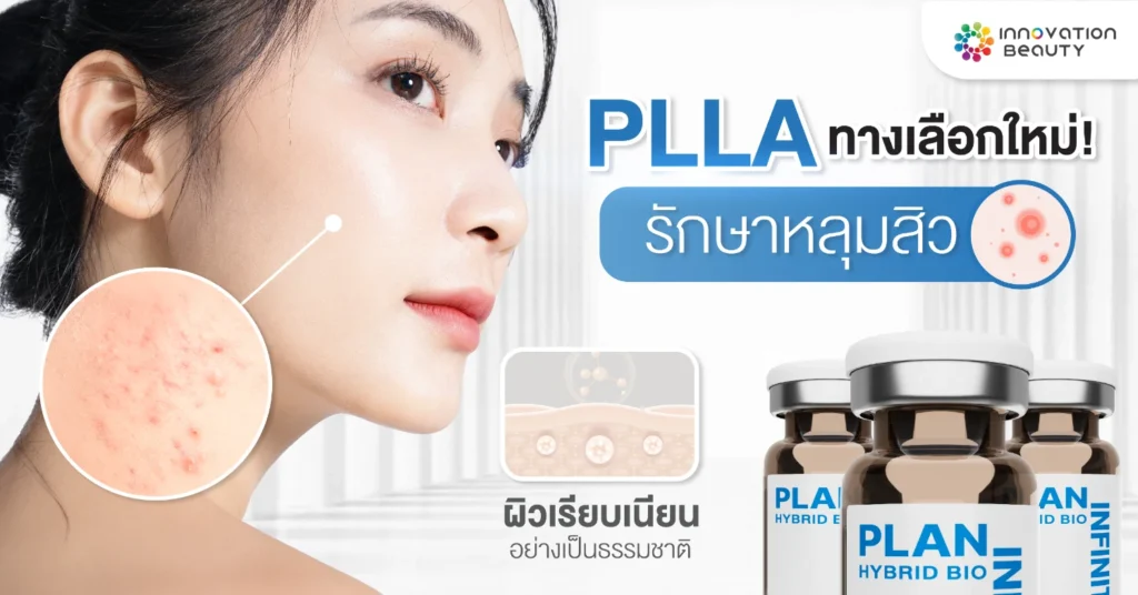 PLLA ทางเลือกใหม่ รักษาหลุมสิว ผิวเรียบเนียนอย่างเป็นธรรมชาติ