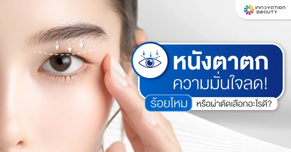 หนังตาตก ความมั่นใจลด ร้อยไหมหรือผ่าตัด เลือกอะไรดี?