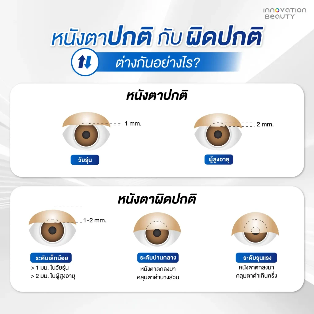 ระดับความรุนแรงของหนังตาผิดปกติ