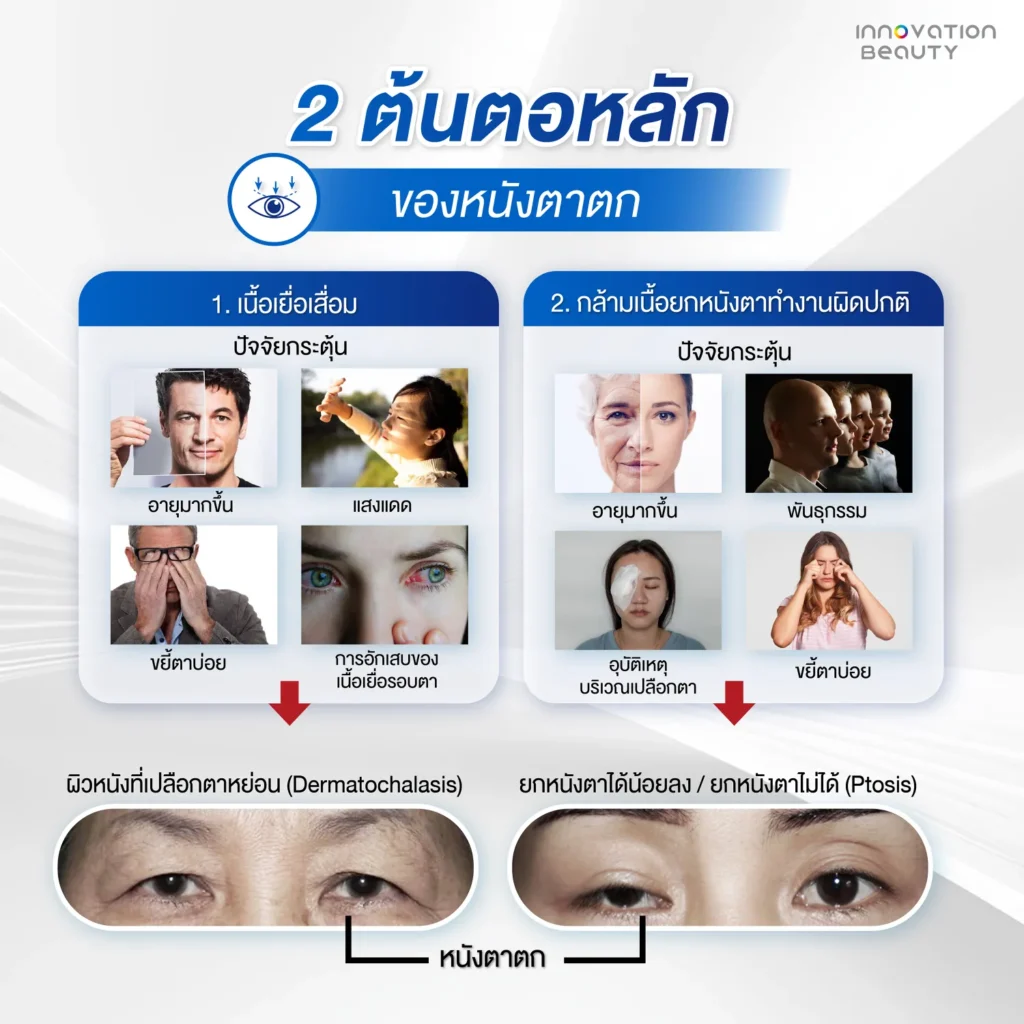 2 ต้นตอหลักของหนังตาตก