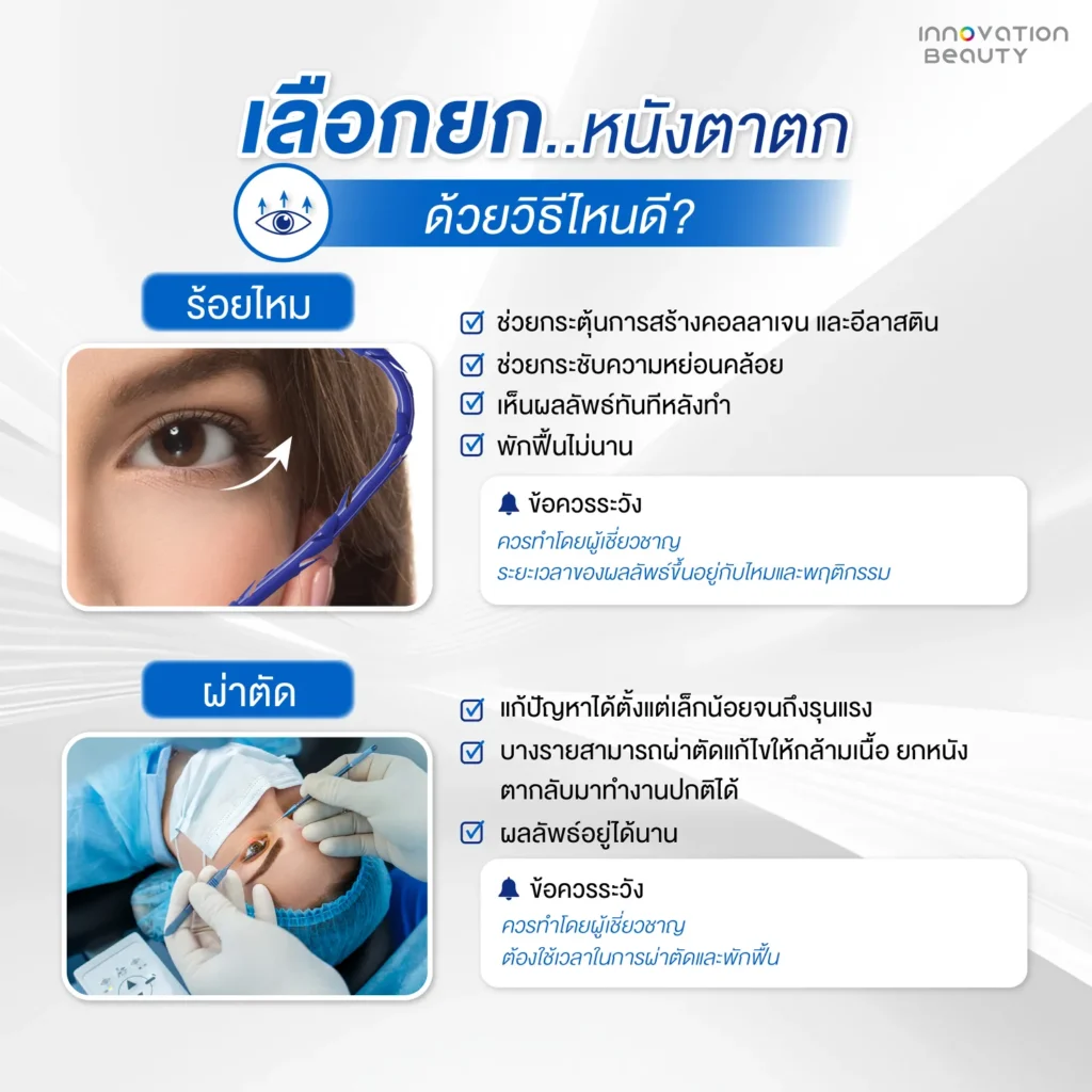 เลือกยกหนังตา ด้วยวิธีไหนดี ?