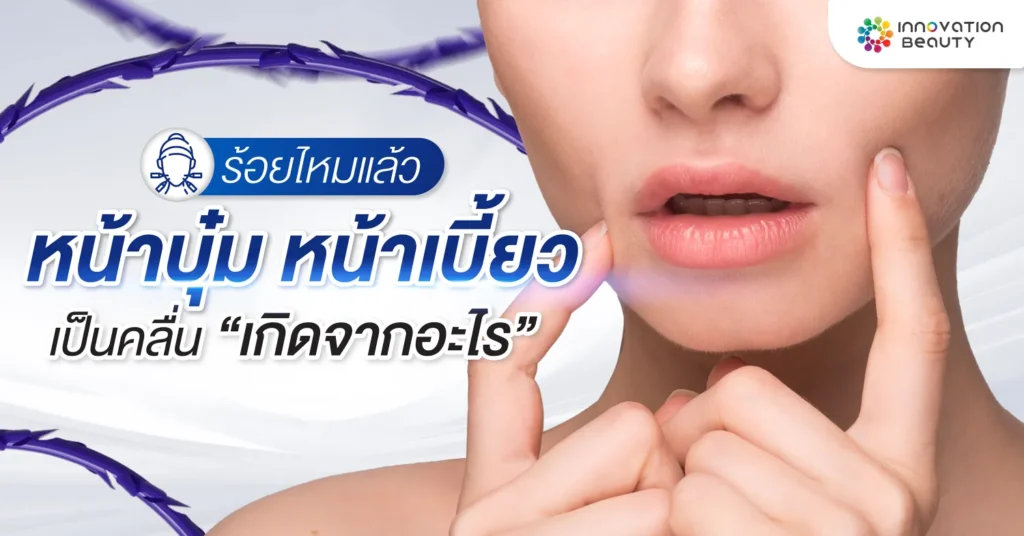 ร้อยไหมแล้วหน้าบุ๋ม หน้าเบี้ยว เป็นคลื่น เกิดจากอะไร?