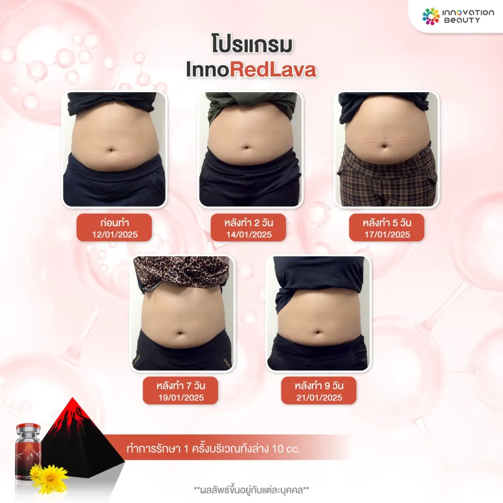 รีวิวจากผู้ใช้จริงที่ลดไขมันพุงด้วย INNOREDLAVA