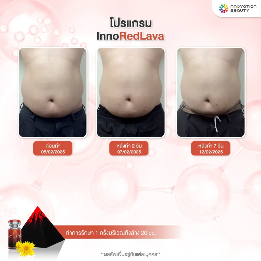 รีวิวจากผู้ใช้จริงที่ลดไขมันพุงด้วย INNOREDLAVA