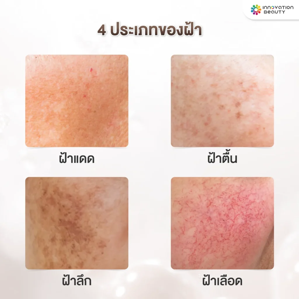 ประเภทของฝ้า