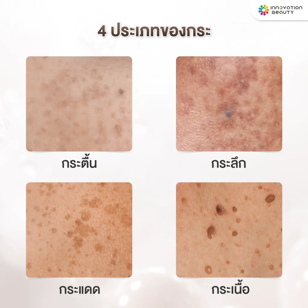 4 ประเภทของกระ