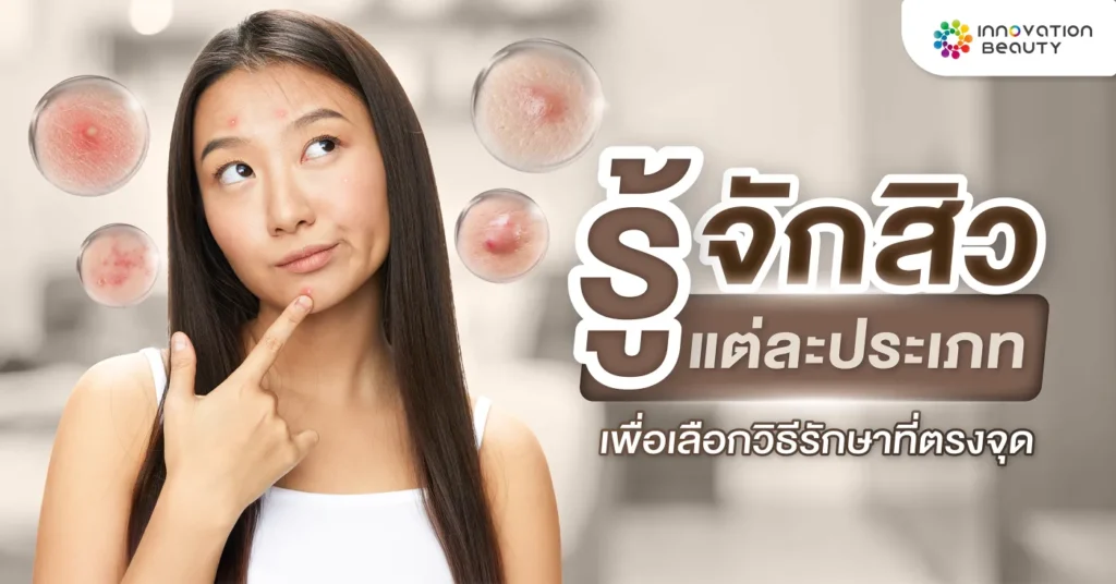 รู้จัก สิว แต่ละประเภท เพื่อเลือกวิธีรักษาที่ตรงจุด