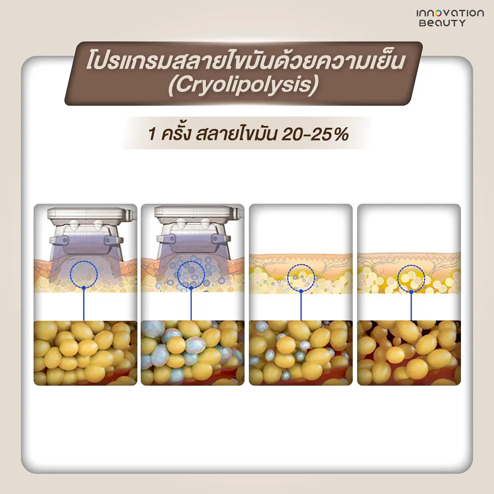 โปรแกรม สลายไขมันด้วยความเย็น (Cryolipolysis)