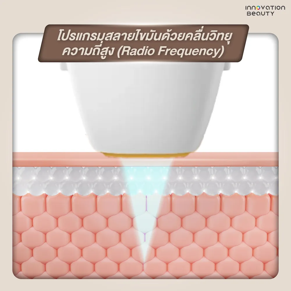 โปรแกรมสลายไขมันด้วย RF คลื่นวิทยุความถี่สูง (Radio Frequency)
