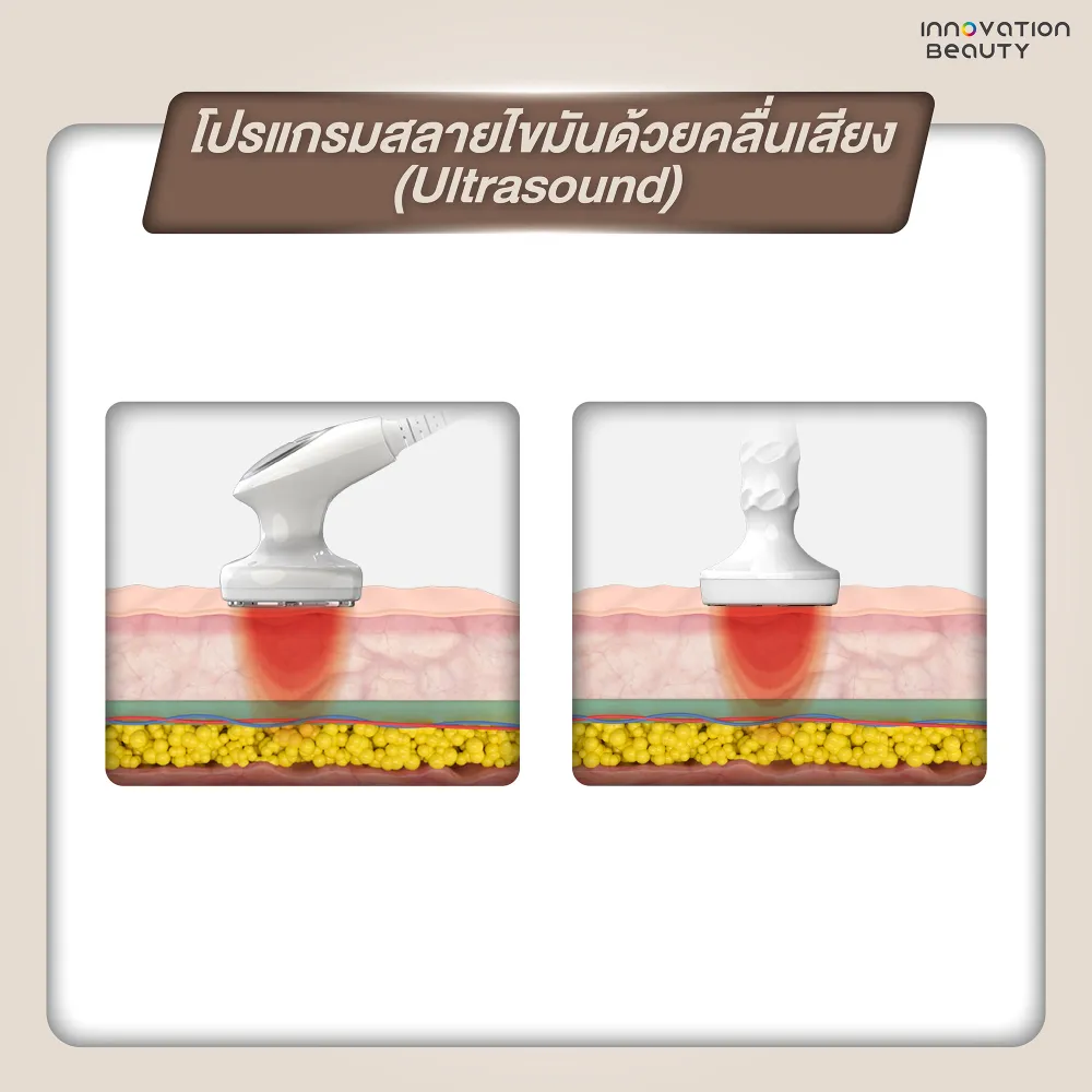 โปรแกรมสลายไขมันด้วยคลื่นเสียง (Ultrasound)