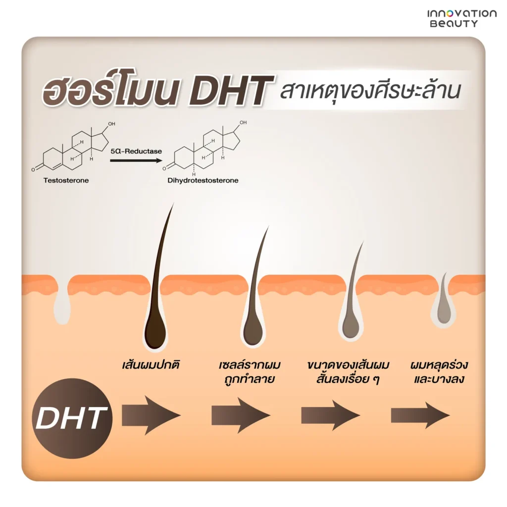 สาเหตุโรคผมร่วงพันธุกรรม และฮอร์โมน