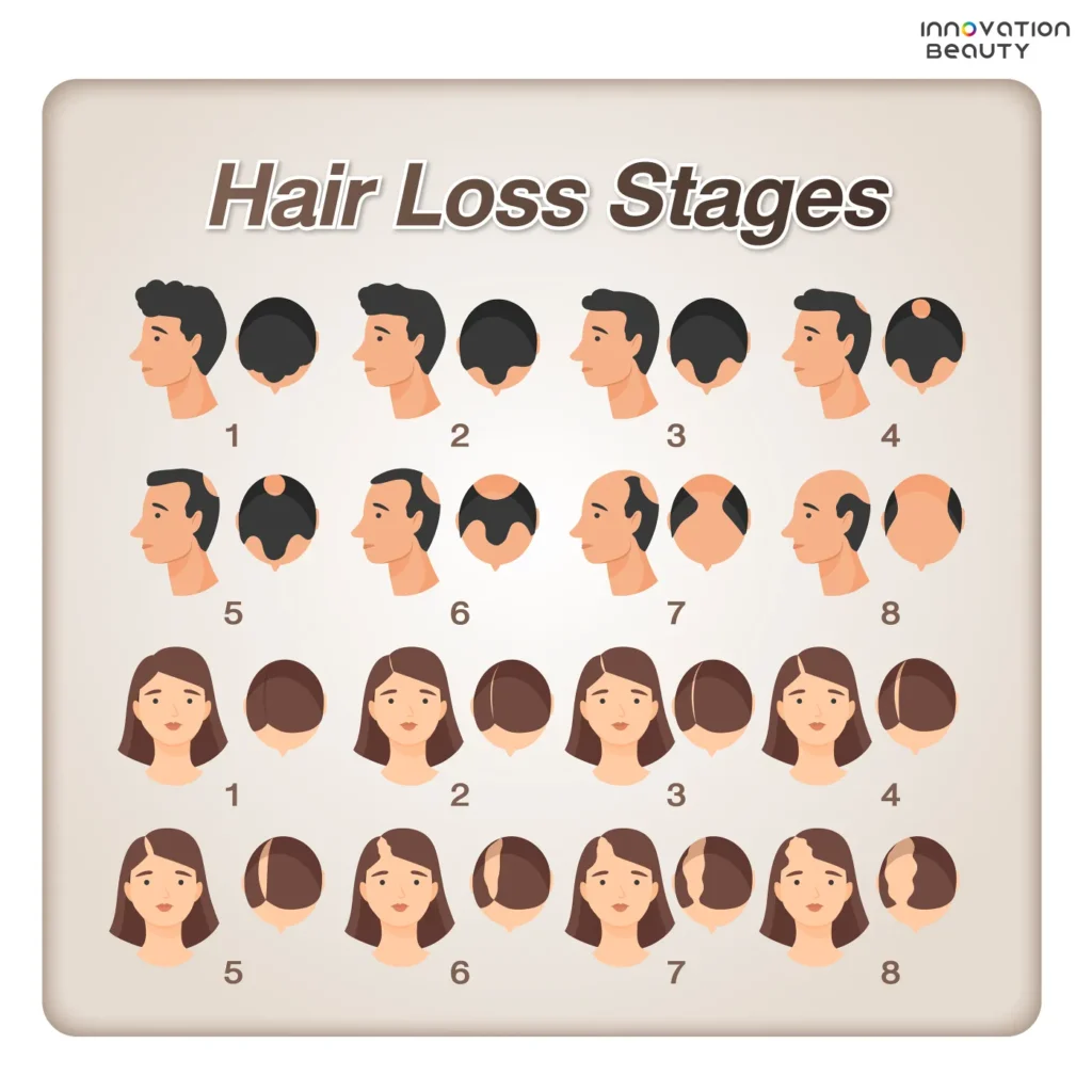 Hair Loss Stages