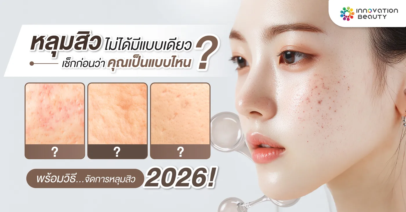 หลุมสิวไม่ได้มีแบบเดียว? เช็กก่อนว่าคุณเป็นแบบไหน