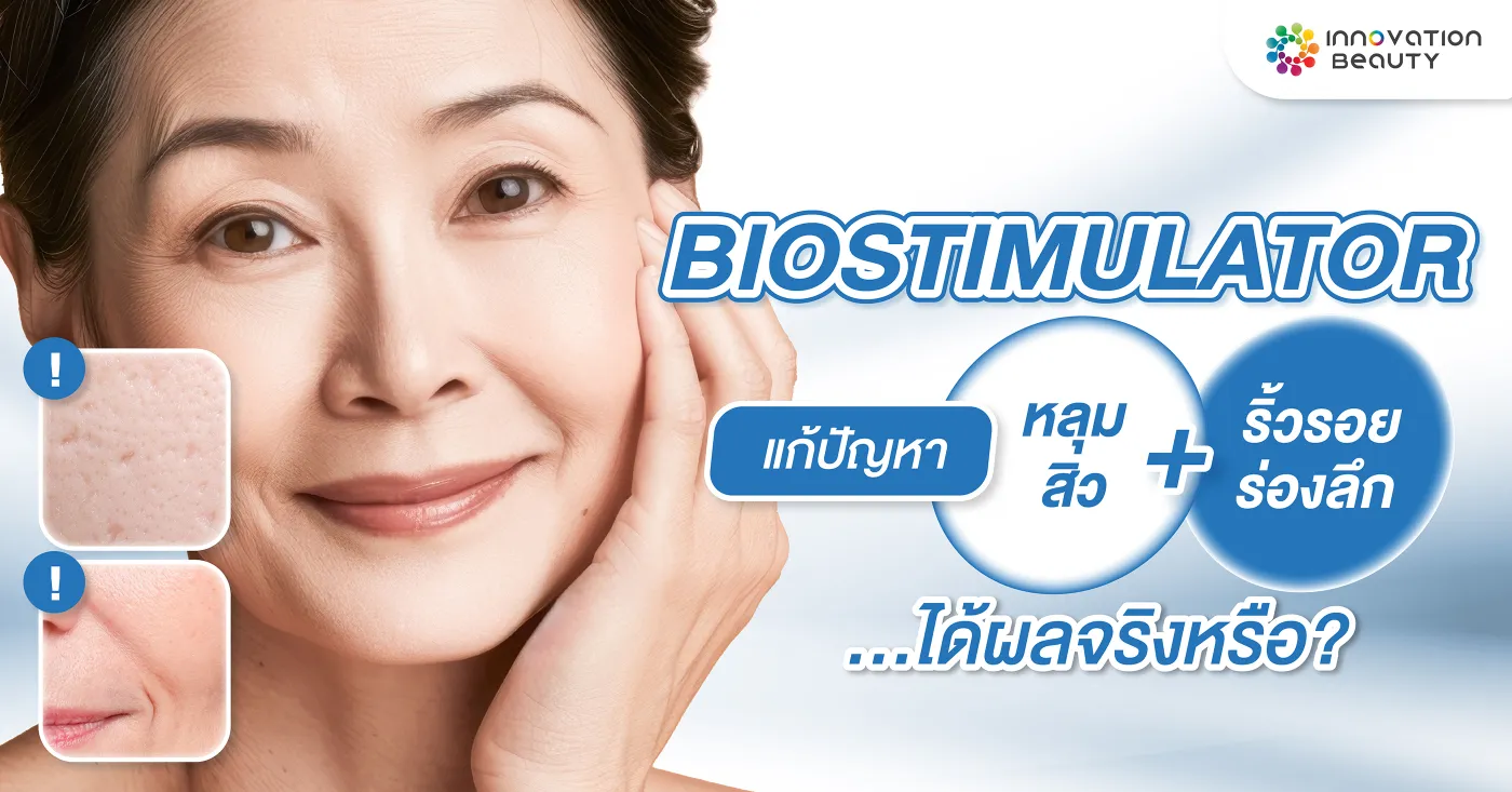 Biostimulator แก้ปัญหา หลุมสิว ริ้วรอยร่องลึก ได้ผลจริงหรือ?