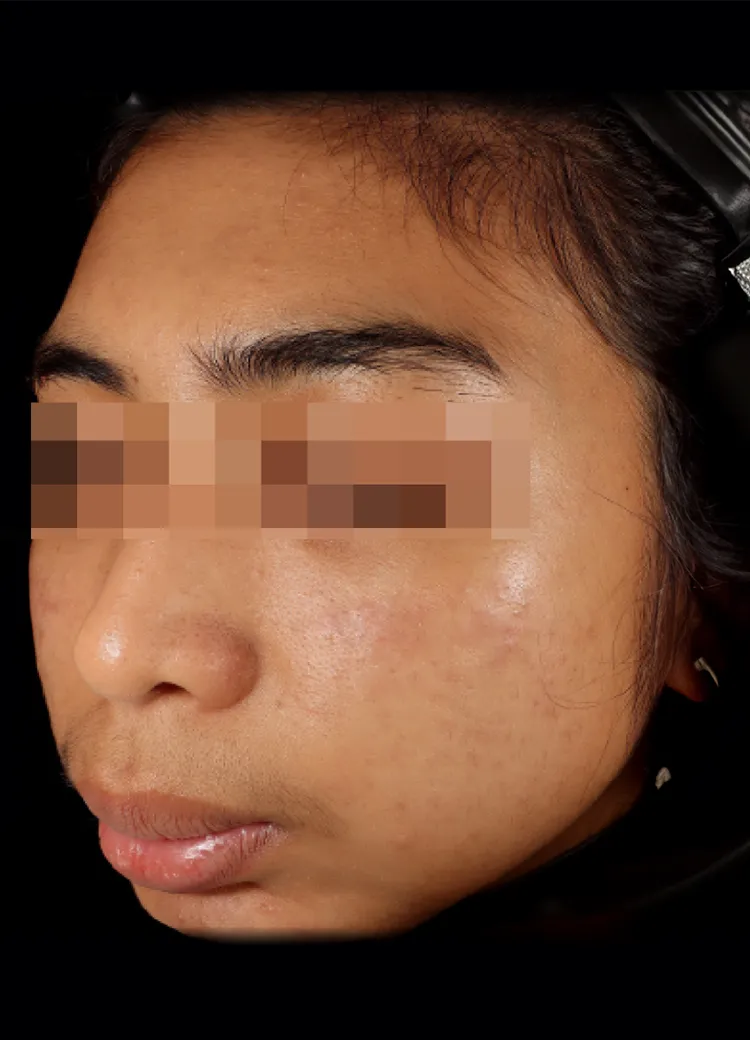 inno Hyal After Image