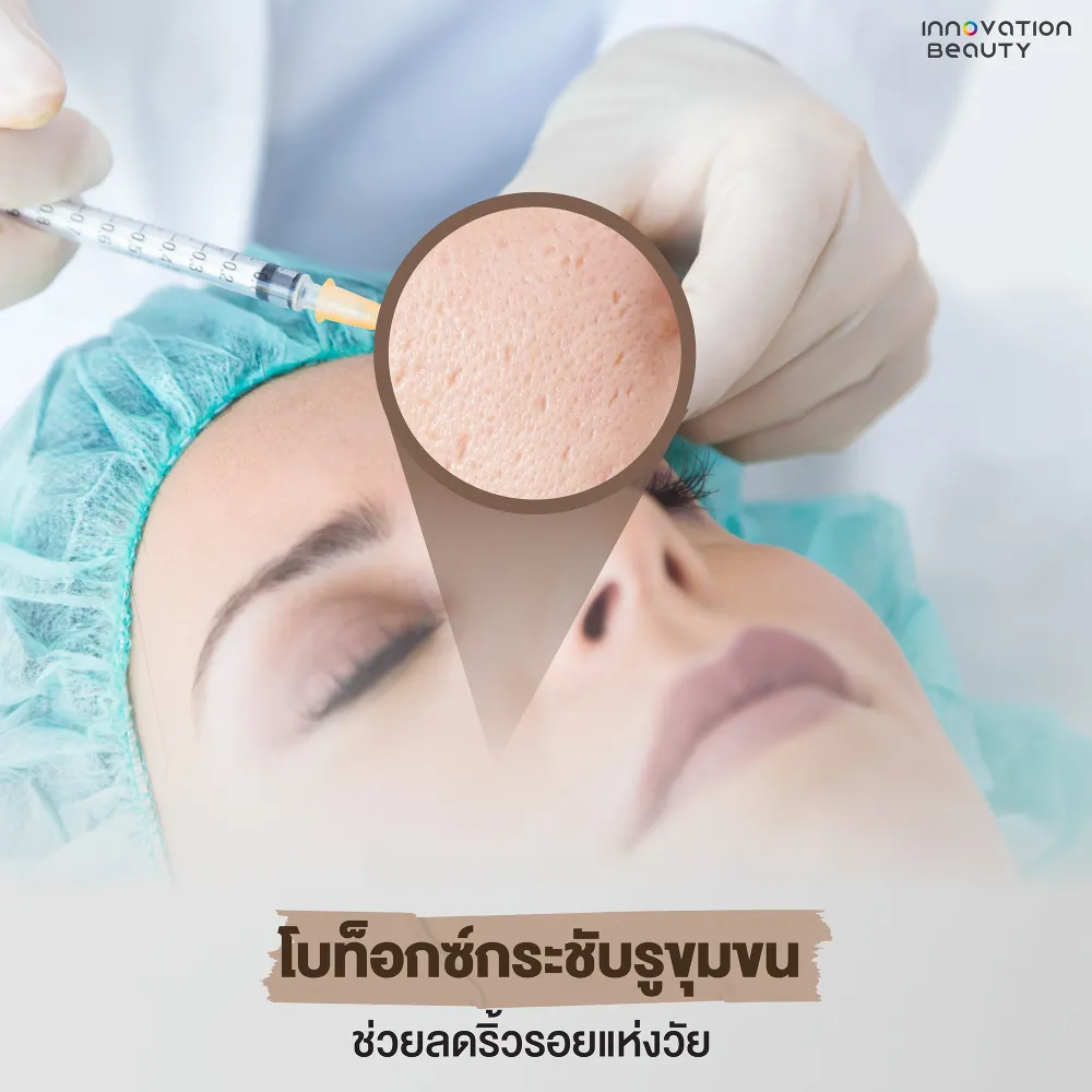 โบท็อกซ์กระชับรูขุมขน ช่วยลดริ้วรอยแห่งวัย