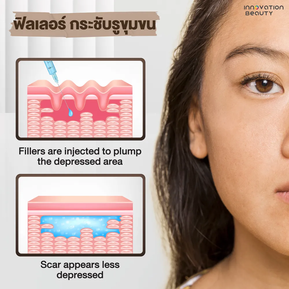 ฟิลเลอร์ กระชับรูขุมขน