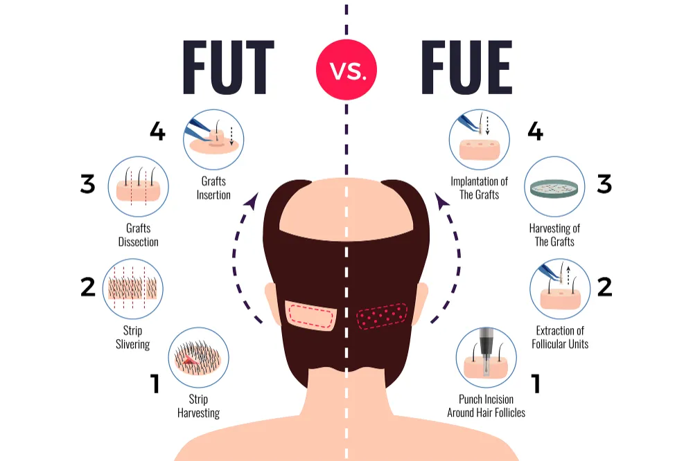 การปลูกผม (Hair Transplant) FUT and FUE