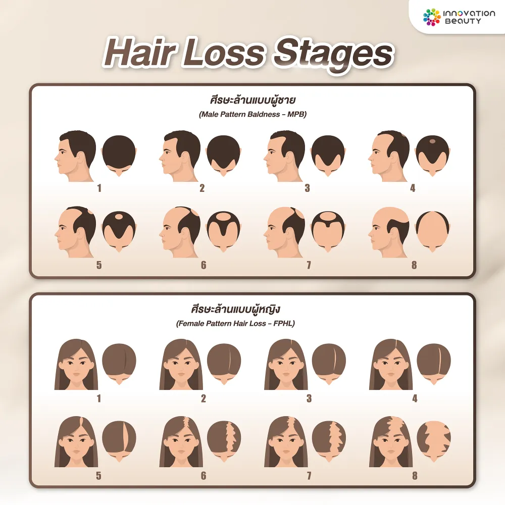 ลักษณะศีรษะล้านแบ่งตามรูปแบบการร่วง