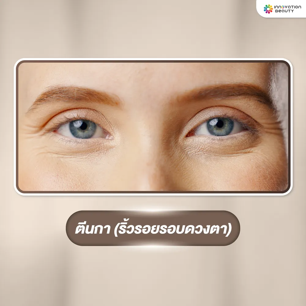 ตีนกา (ริ้วรอยรอบดวงตา)