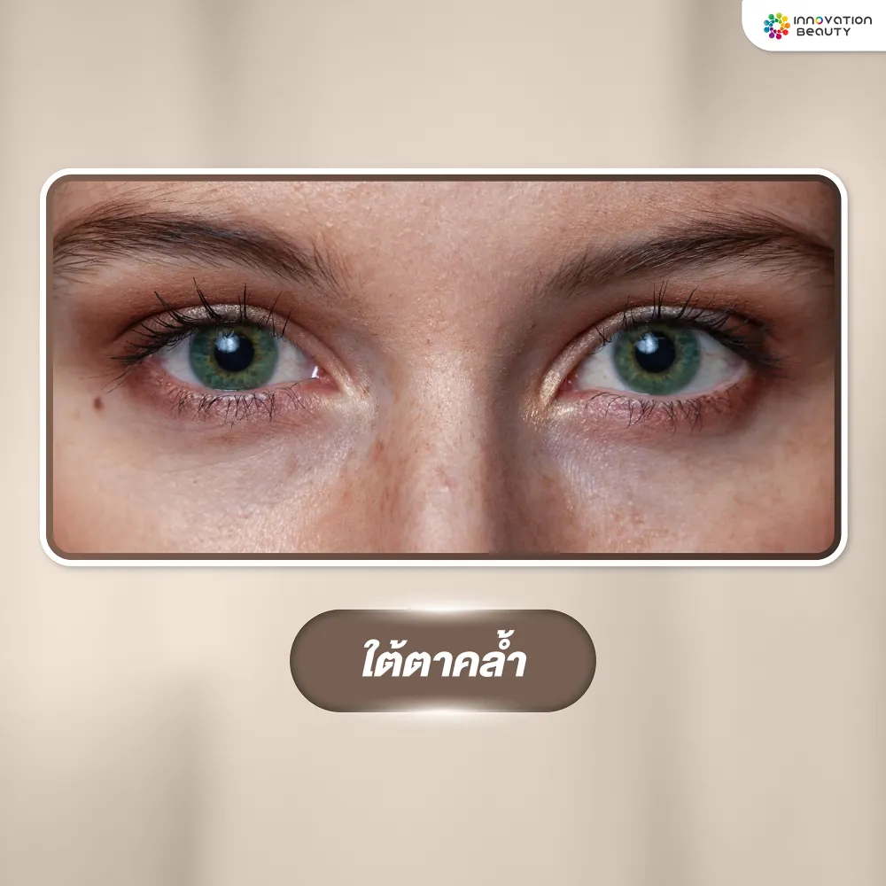 ปัญหาผิวรอบดวงตา ใต้ตาคล้ำ