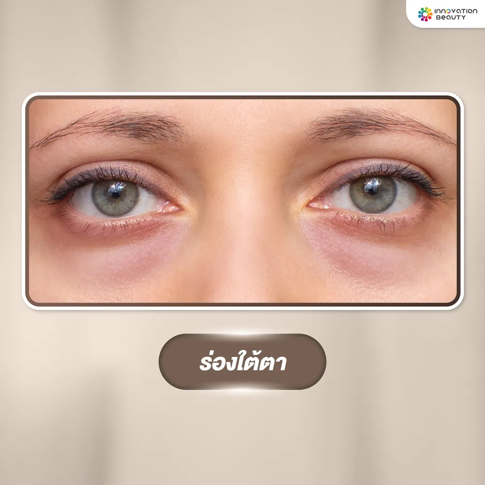 ปัญหาผิวรอบดวงตา ร่องใต้ตา