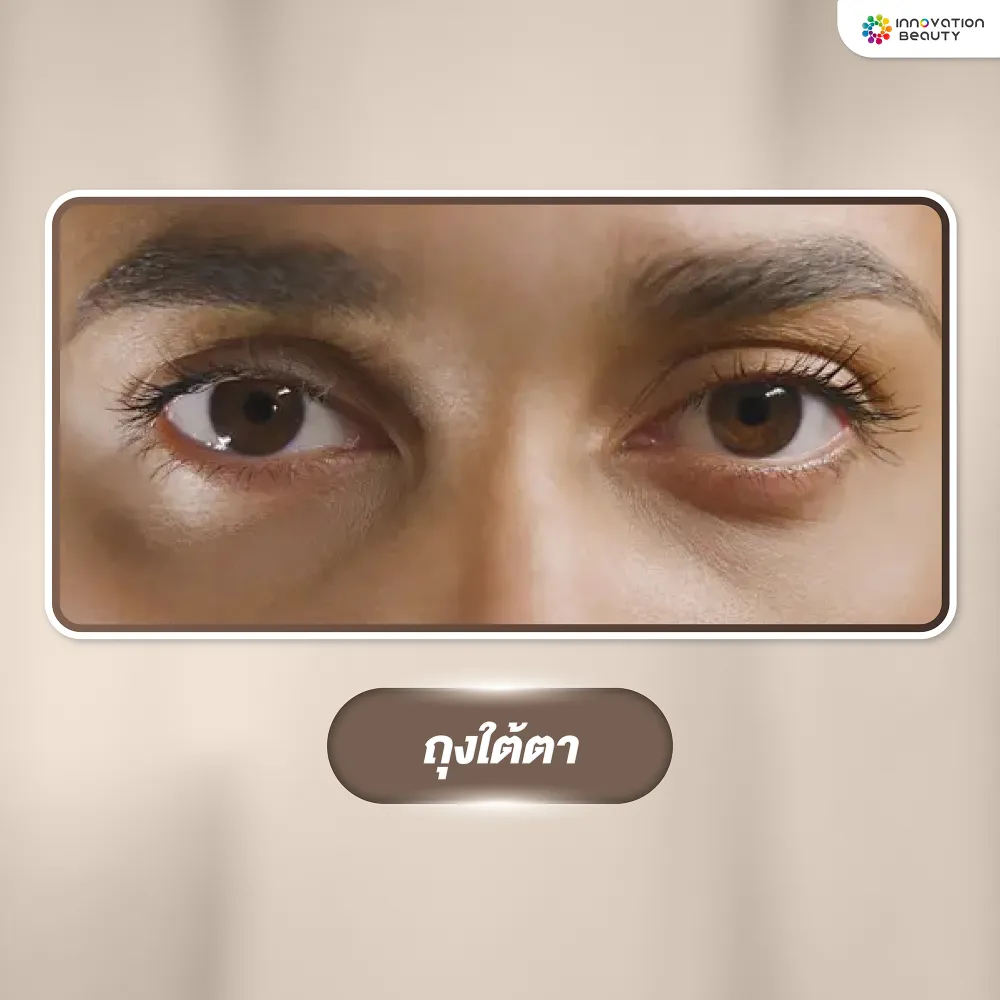 ปัญหาผิวรอบดวงตา ถุงใต้ตา