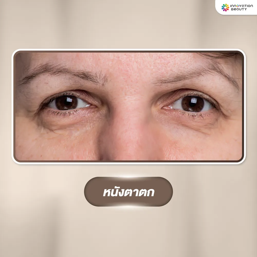ปัญหาผิวรอบดวงตา หนังตาตก