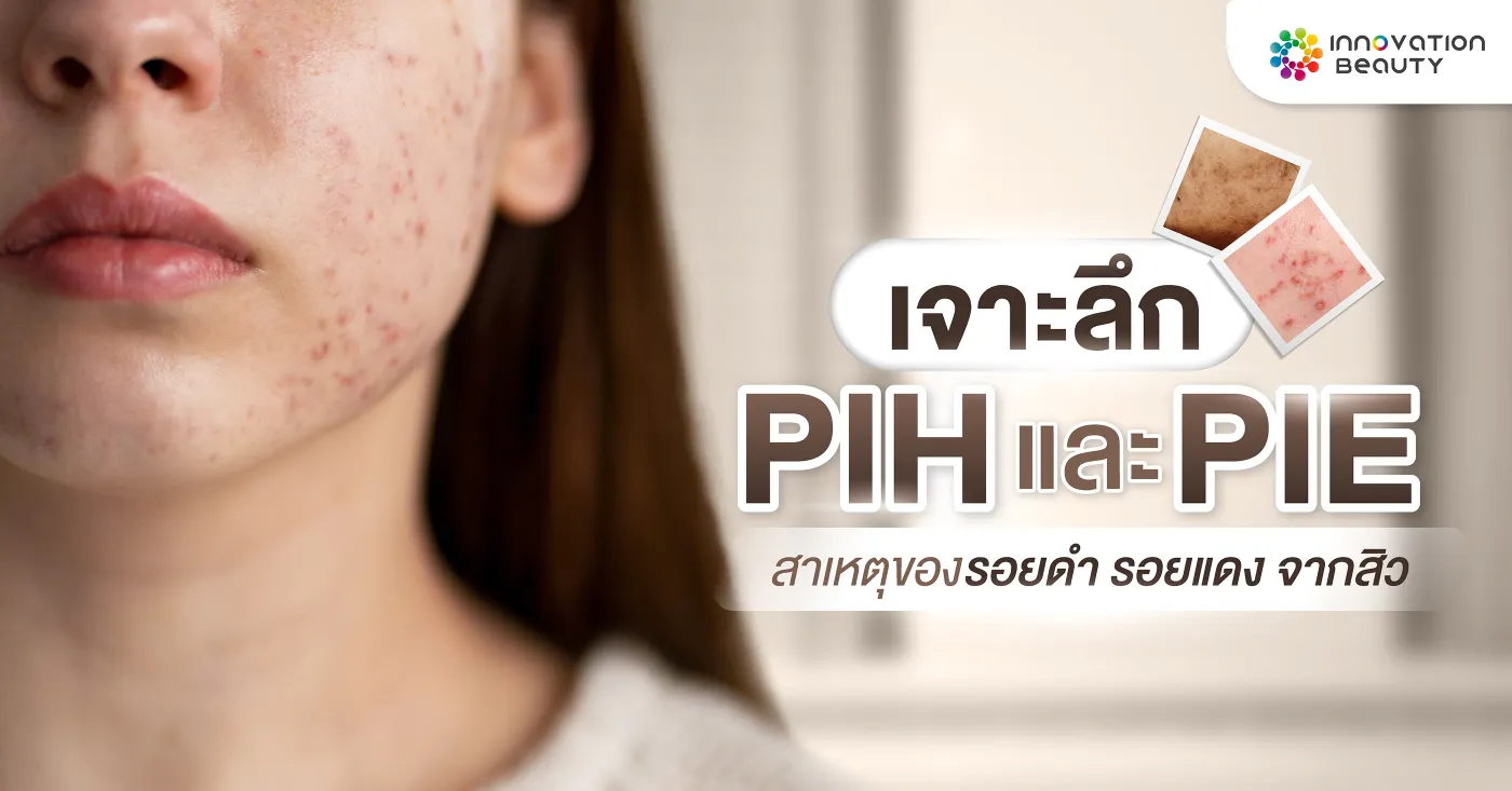 เจาะลึก PIH และ PIE สาเหตุของรอยดำ รอยแดง จากสิว