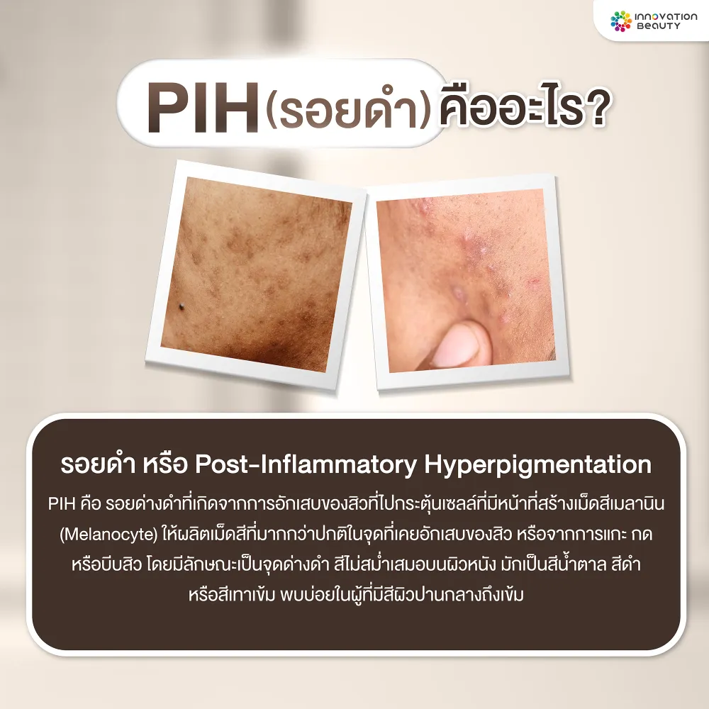 PIH คืออะไร? (รอยดำ)