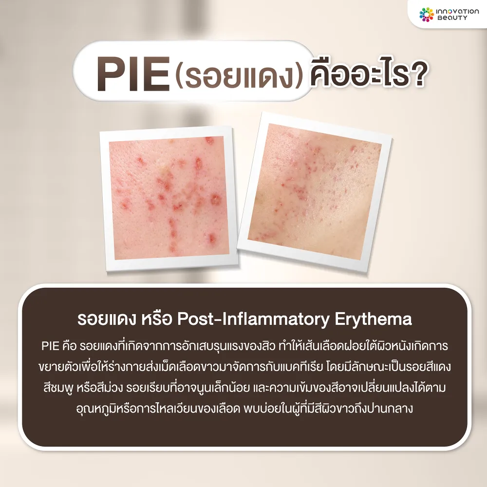 PIE คืออะไร? (รอยแดง)