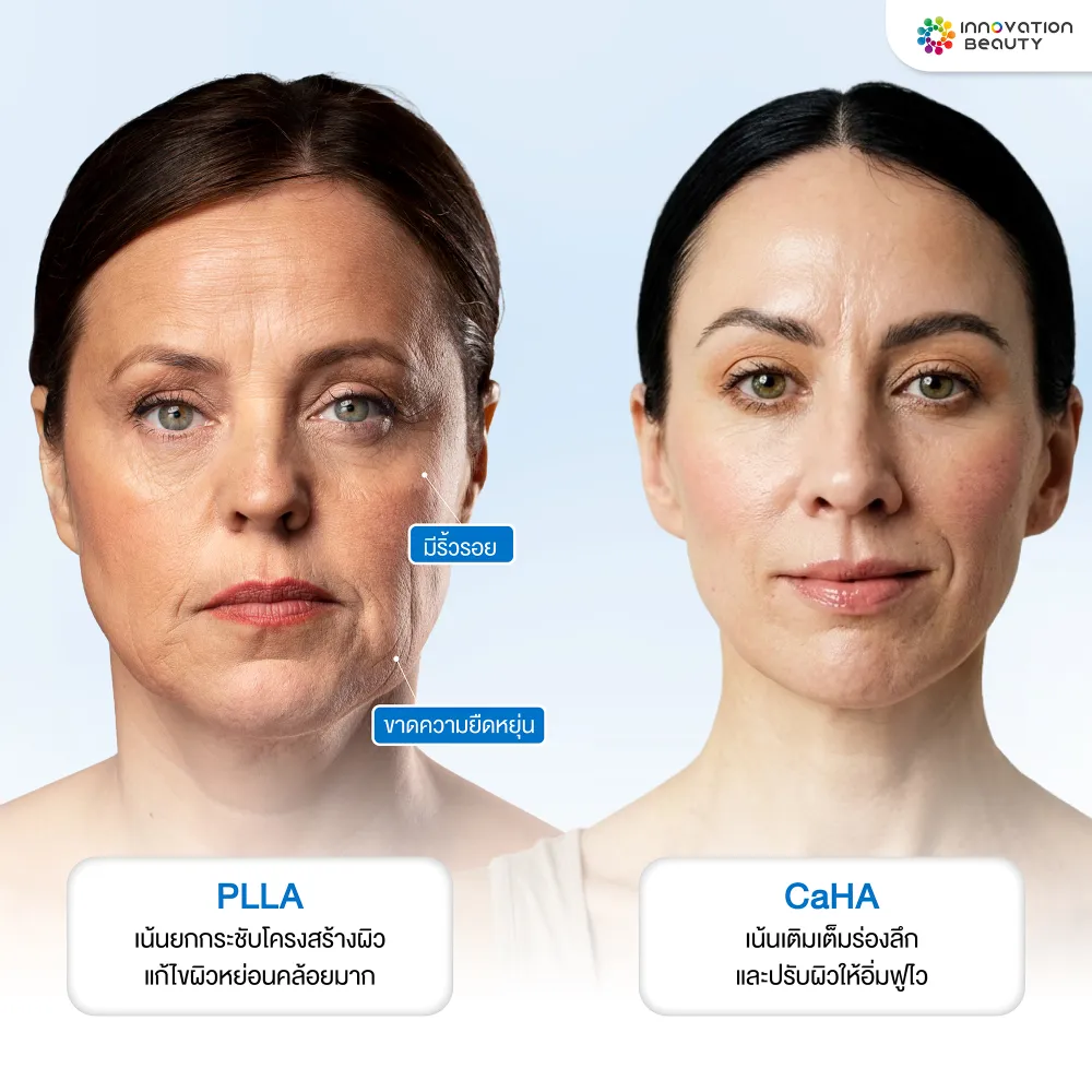 PLLA vs CaHA เหมาะกับใคร และปัญหาผิวแบบไหน