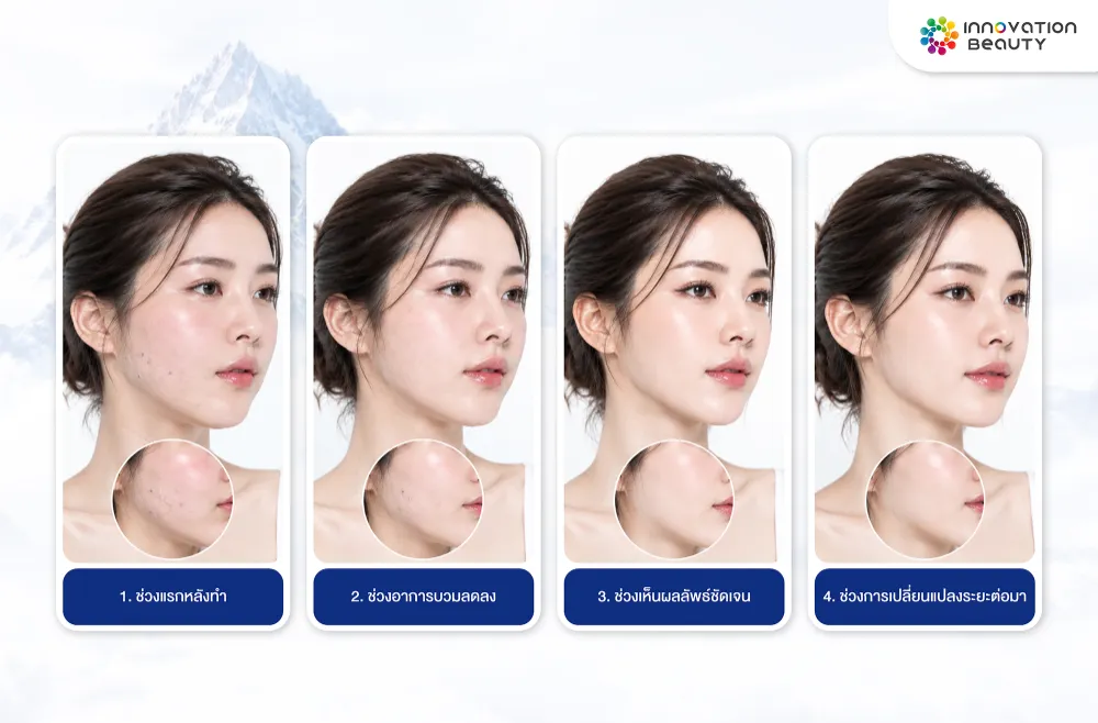 ผลลัพธ์หลังร้อยไหมเปลี่ยนแปลงอย่างไรตามช่วงเวลา